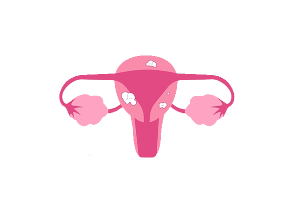 Uterine Fibroid