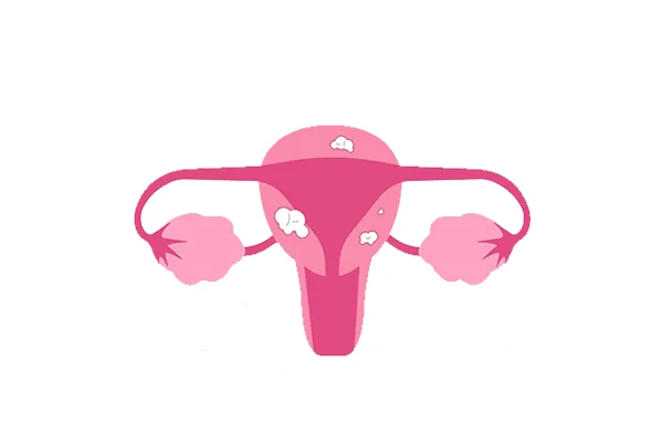 Uterine Fibroid