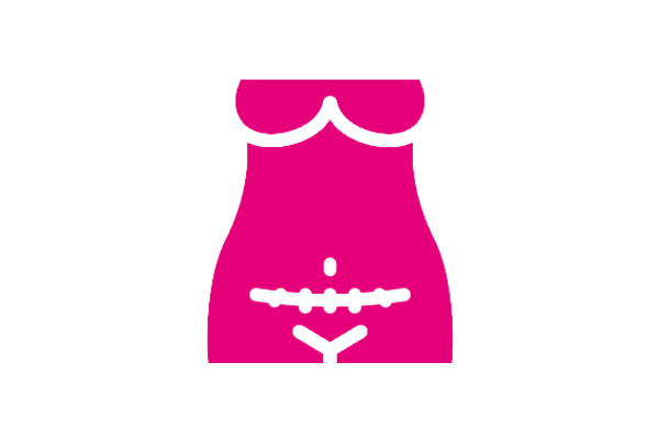 Cesarean Delivery