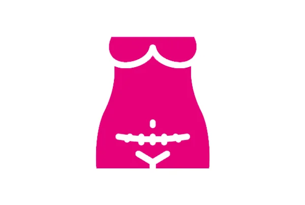 Cesarean Delivery